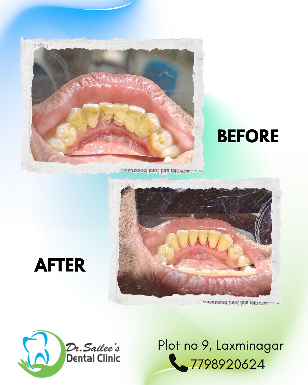 SCALING (TEETH CLEANING)