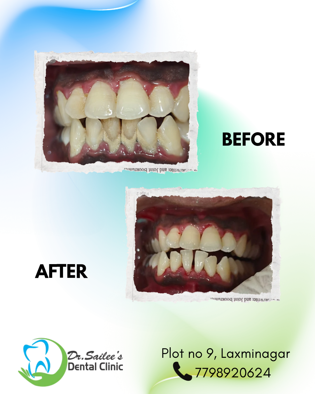 Teeth cleaning in nagpur