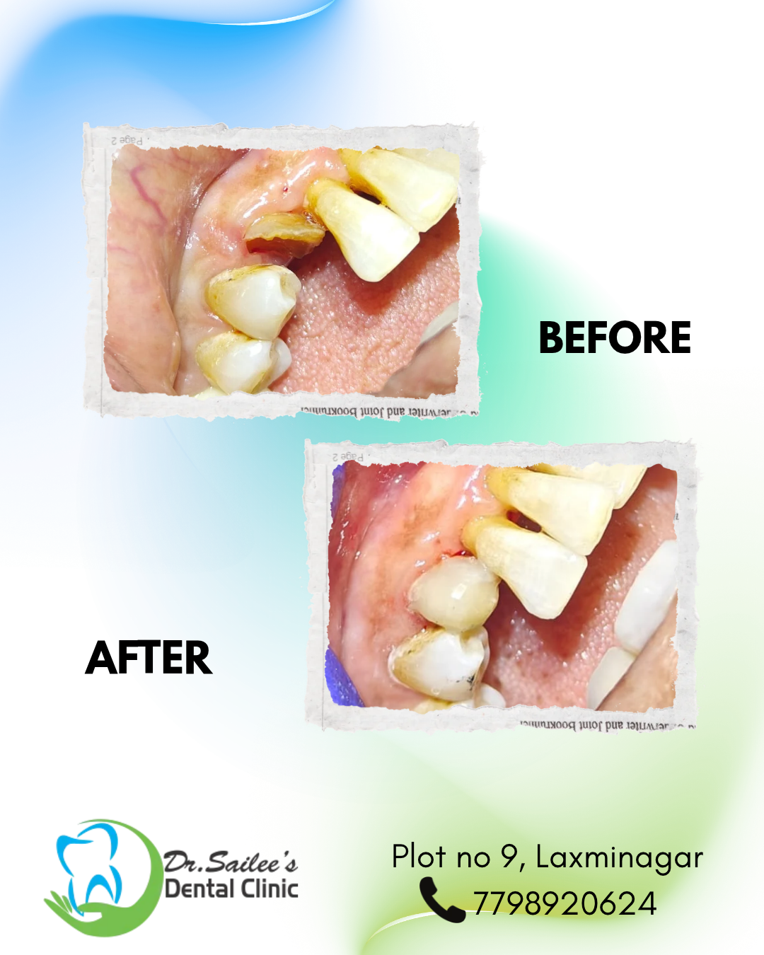 composite build up of badly damaged tooth.