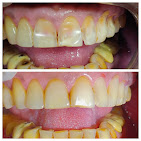 Composite Veneers