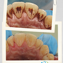 Teeth cleaning