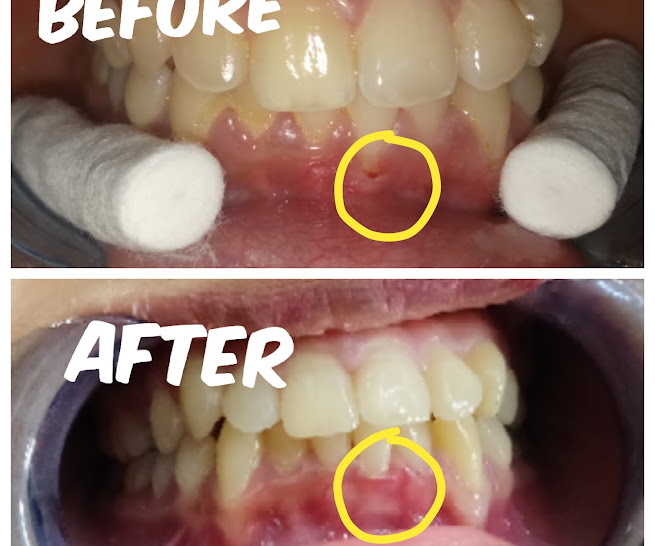 Periodontal treatment
