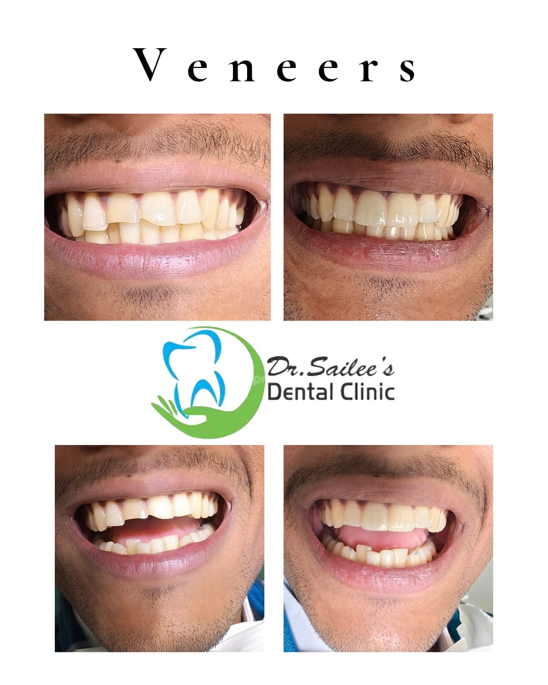 Smile designing