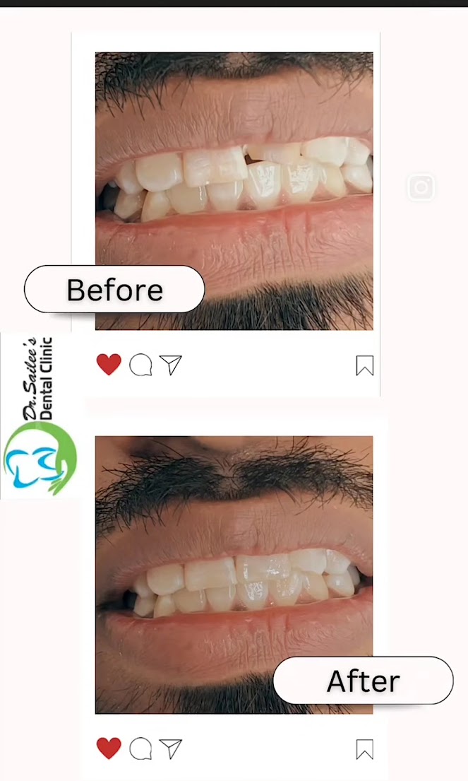 Ceramic veneers