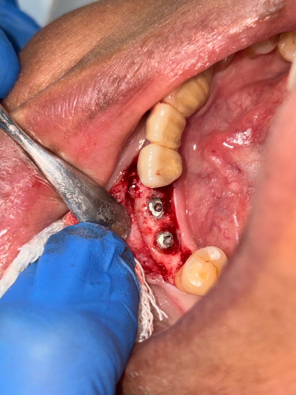Dental Implants